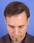 After Hair Transplant&nbsp;Revision